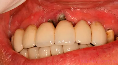 Периимплантит в стоматологии - какие симптомы, опасность и методы лечения