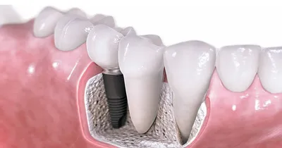Имплантация зубов – Зубная клиника 24 часа. Кариес: виды, лечение без бор  машины, стоимость.