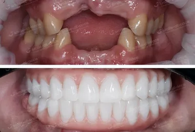 Имплантация и одновременное протезирование зубов. Фото до и после