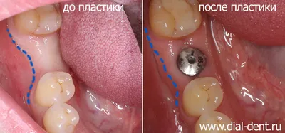 Пластика десны в области имплантации и протезирование жевательного зуба