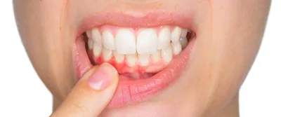 Отторжение зубного имлпанта — как понять прижился или нет, что делать