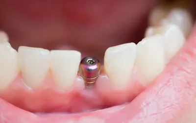 Имплантация зубов - десна - Cтоматология Май