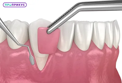 Имплантация сразу после удаления зубов - удаление зуба и имплантация  одновременно