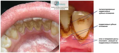 Онемение после имплантации зубов: что делать? Статьи о стоматологии от  Belgravia Dental Studio