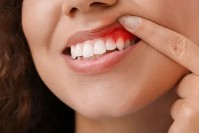 Осложнения после несъемного протезирования зубов в стоматологии