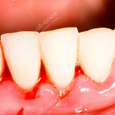 Осложнения после имплантации зубов верхней и нижней челюсти