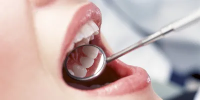 Воспаление десен: чем можно лечить – стоматология ПрезиДЕНТ