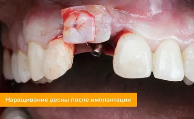 Лечение осложнений после имплантации зубов в Санкт-Петербурге