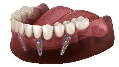 Болит десна при жевании Причины, осложнения - Полезные статьи на сайте  стоматологической клиники Церекон