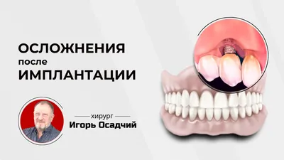 Рекомендации пациенту после имплантации зубов