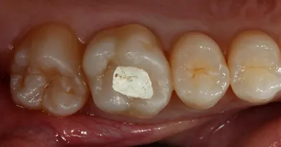 Осложнения после имплантации зубов. - YouTube