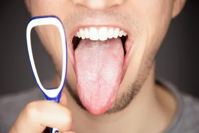 Глоссит: что делать, если воспалился язык? | Здоровье