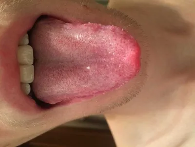 Почему воспаление сосочков на корне и кончике языка может привести к их  увеличению?