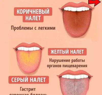 Как определить болезни внутренних органов по состоянию языка?