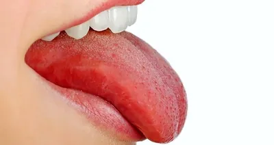 Воспаление сосочков на языке – Симптомы, причины и лечение