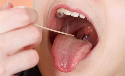 Причины и лечение боли корня языка сбоку