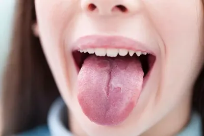 Глоссит (воспаление языка): причины, симптомы и лечение