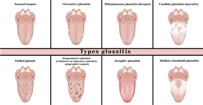 Глоссит: классификация, причины, симптомы, лечение и профилактика
