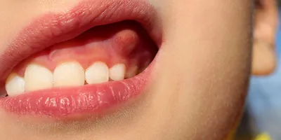 Десна: функции, структура и важность здоровья полости рта