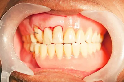 Что такое кандидоз полости рта? | parodontax