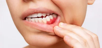 Важный этап лечения воспаления десен – чистка зубов у стоматолога