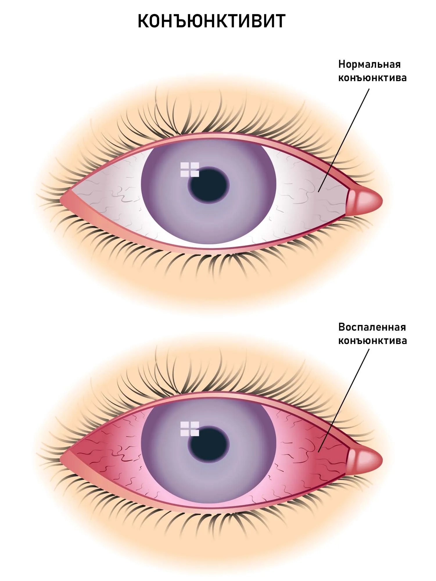 Конъюнктивит Симптомы Лечение Фото
