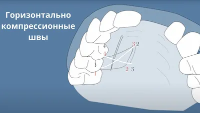 Когда снимают швы после имплантации зубов, больно или нет?