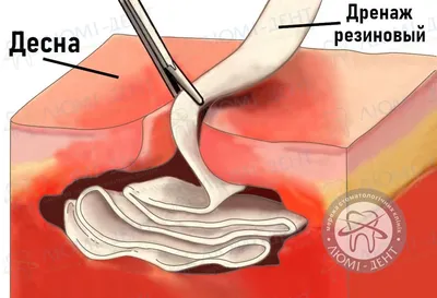 Дренаж В Десне Зуба Хирургия После Операции ЛюмиДент