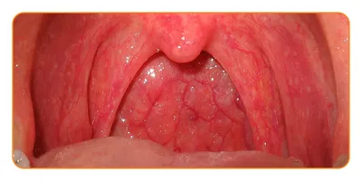 Воспаление горла, лечение, как выглядит, почему воспаляется горло — блог  Фурасол®