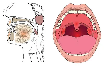 Причины боли в горле и гортани: что стоит знать?