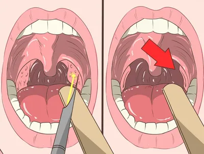 Гнойные волдыри в горле: причины, симптомы и лечение