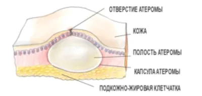 Атерома мошонки, жировик на яичке почему образуется как выглядит, как  удалить