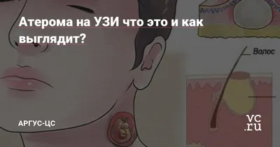 Атерома на УЗИ что это и как выглядит? — Аргус-ЦС на vc.ru