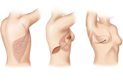 Комплекс реконструктивных операций помог пациентке восстановить форму  груди, которая была утрачена в связи с наличием ракового