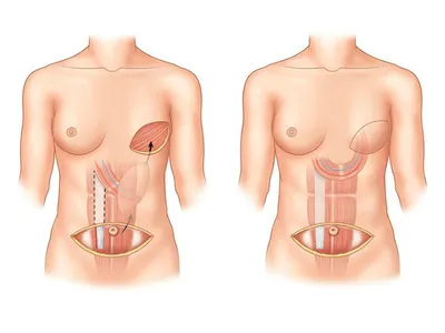 Пластика груди после удаления - Майский И. А.