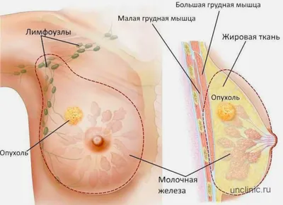 Наружные протезы и специальное белье после мастэктомии | Равный рядом | Дзен