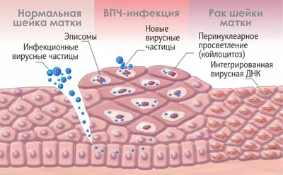 Вирус папилломы человека: список типов, как лечить ВПЧ? - 18 декабря 2018 -  59.ru