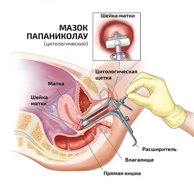 Общие Места Генитальные Бородавки, Папилломы Человека Поражения ВПЧ У Мужчин,  И Крупным Планом Вид ВПЧ. 3D Иллюстрации Фотография, картинки, изображения  и сток-фотография без роялти. Image 72535690