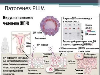 Вирус папилломы человека лечение. Как лечить вирус папилломы человека? ВПЧ  у мужчин! - YouTube