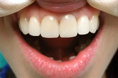Временные коронки - зачем устанавливать временный протез зуба (коронки) |  НоваДент