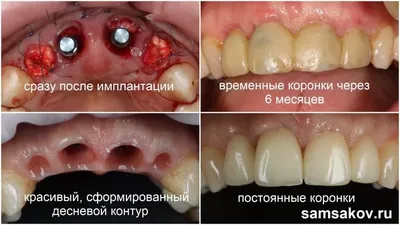 Изготовление временных коронок | зуботехническая лаборатория интердентос