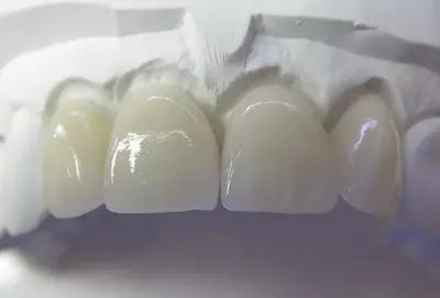 Съемные зубные протезы: какие лучше, виды, преимущества, методы  протезирования, особенности