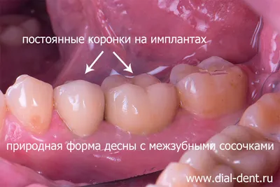 Протезирование зубов - Cтоматология \"Улыбка\"