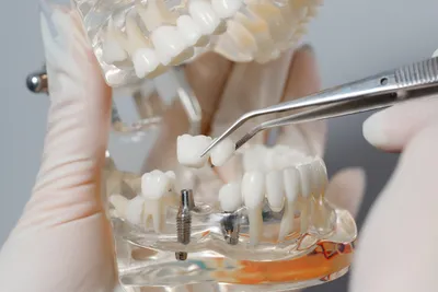Временная пластмассовая коронка недорого в стоматологии Кредо в Реутове и  Новокосино