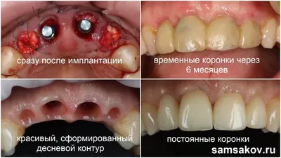 Зачем на имплант нужно ставить временные коронки | Альянс бьюти-ортопедов,  Москва