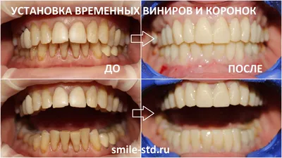 Установка виниров и коронок женщинам после 50 лет. Клиника Smile STD в  Измайлово