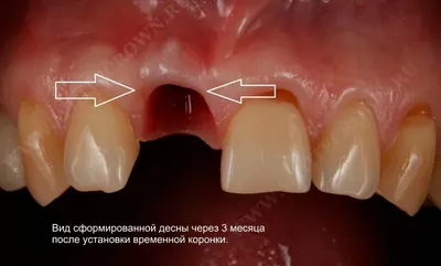 Установка коронок на передние зубы | Цена восстановления передних зубов от  12000руб в стоматологии Доктор Бон