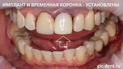 Что такое зубная коронка, и когда нужна установка временной коронки на зуб?