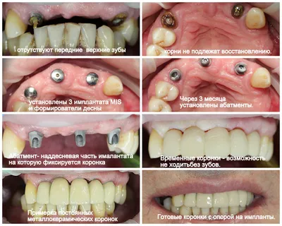 Поставить временные протезы на зубы - полные и частичные системы