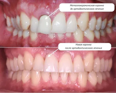 Коронка На Зуб Какие Бывают 299 Фото До После ЛюмиДент